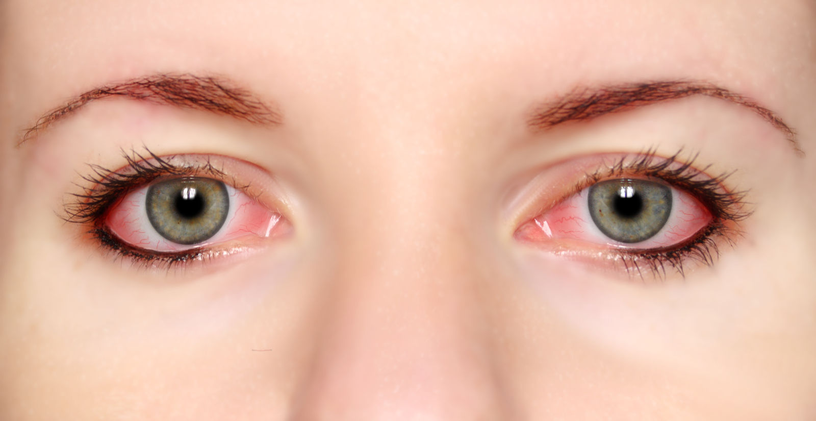 Detalle de dos ojos con conjuntivitis