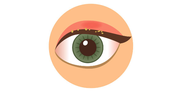 Imagen blefaritis: qué es la conjuntivitis, síntomas, causas, tratamiento y prevención | Asociación Española de Optometristas Unidos