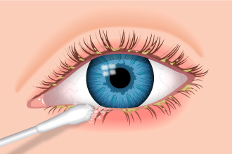 Prevención de la blefaritis de la Asociación Española de Optometristas Unidos Imagen prevención de la blefaritis de la Asociación Española de Optometristas Unidos