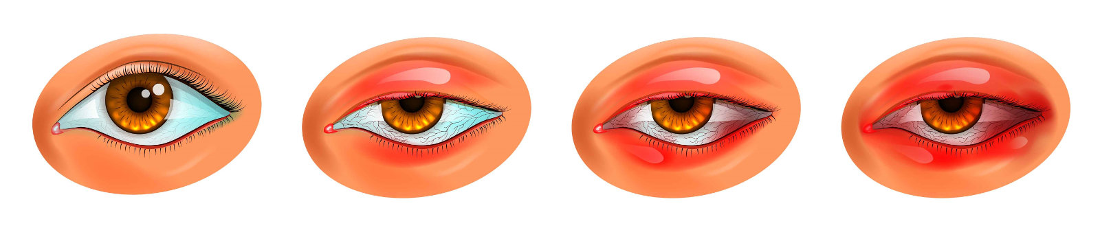 Qué es la blefaritis de la Asociación Española de Optometristas Unidos Imagen qué es la blefaritis de la Asociación Española de Optometristas Unidos