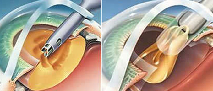 Operación de cataratas de la Asociación Española de Optometristas Unidos Operación de cataratas de la Asociación Española de Optometristas Unidos