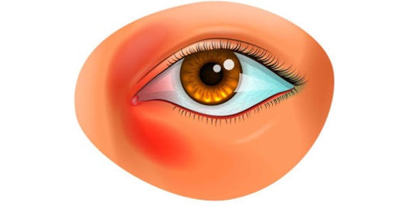 Imagen Dacriocistitis: qué es, síntomas, causas y tratamiento