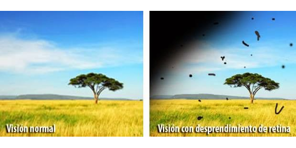 Imagen Desprendimiento de retina: qué es, síntomas, causas, diagnóstico y tratamiento? | Asociación Española de Optometristas Unidos