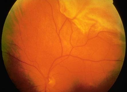 Ojo causante del desprendimiento de retina de la Asociación Española de Optometristas Unidos Imagen ojo causante del desprendimiento de retina de la Asociación Española de Optometristas Unidos