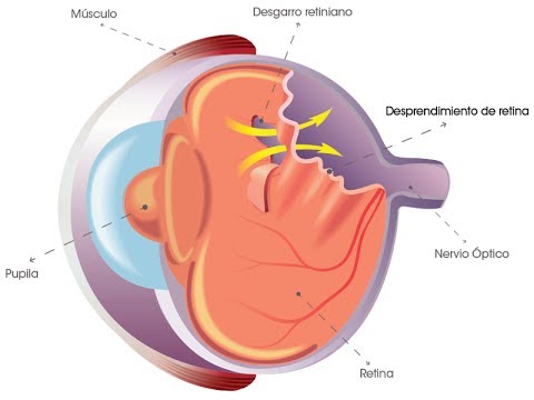 Gráfico desprendimiento de retina de la Asociación Española de Optometristas Unidos Imagen gráfico desprendimiento de retina de la Asociación Española de Optometristas Unidos