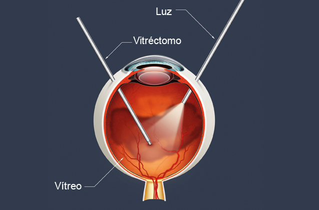 Vitrectomía desprendimiento de retina de la Asociación Española de Optometristas Unidos Imagen Vitrectomía desprendimiento de retina de la Asociación Española de Optometristas Unidos