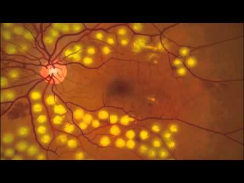Cirugía con láser (fotocoagulación) desprendimiento de retina de la Asociación Española de Optometristas Unidos Imagen cirugía con láser (fotocoagulación) desprendimiento de retina de la Asociación Española de Optometristas Unidos