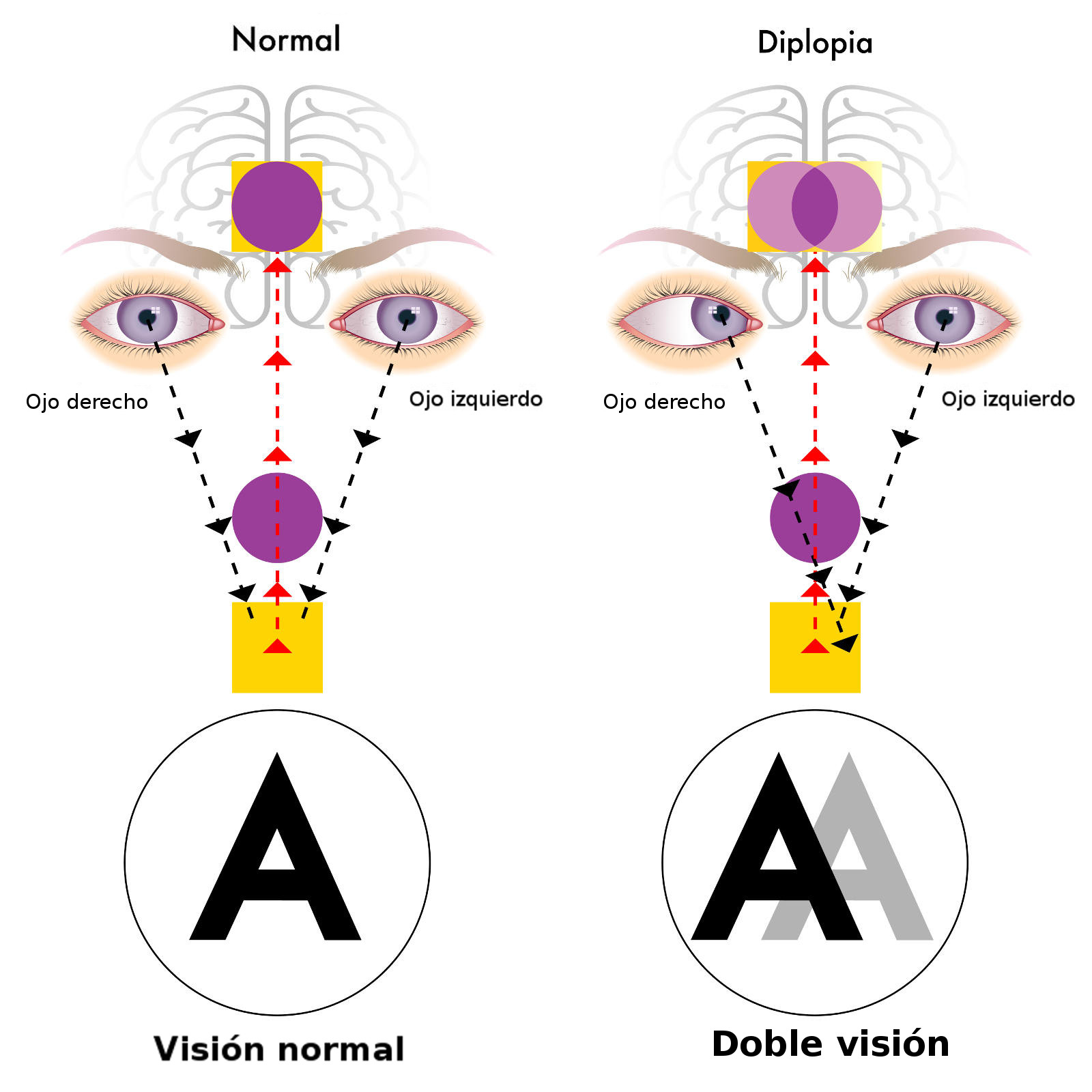 Tratamiento de la diplopía | Asociación Española de Optometristas Unidos Imagen Tratamiento de la diplopía en la Asociación Española de Optometristas Unidos