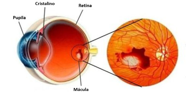 Imagen Degeneración macular asociada a la edad (DMAE): qué es, síntomas, causas, prevención y tratamiento | Asociación Española de Optometristas Unidos