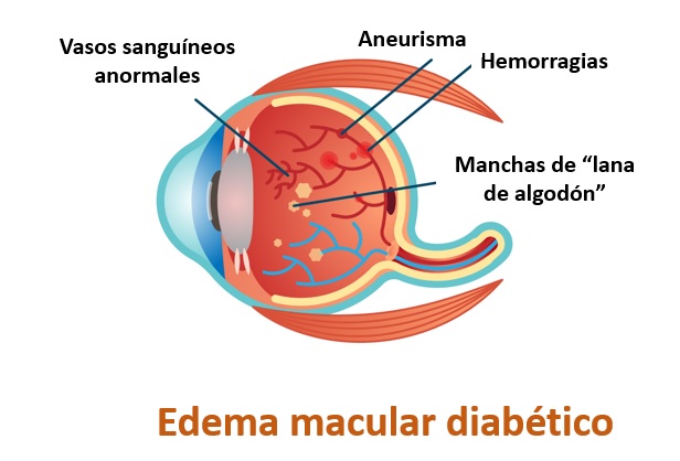 Causas del edema macular de la Asociación Española de Optometristas Unidos Imagen causas del edema macular de la Asociación Española de Optometristas Unidos