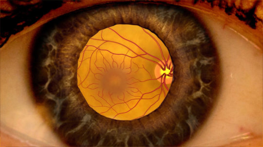 Que és el edema macular de la Asociación Española de Optometristas Unidos Imagen que és el edema macular de la Asociación Española de Optometristas Unidos