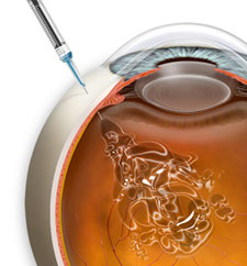 Tratamiento del edema macular de la Asociación Española de Optometristas Unidos Imagen tratamiento del edema macular de la Asociación Española de Optometristas Unidos