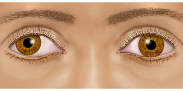 Imagen Estrabismo: ¿qué es el estrabismo? Su detección, síntomas, causas y tratamiento | Asociación Española de Optometristas Unidos