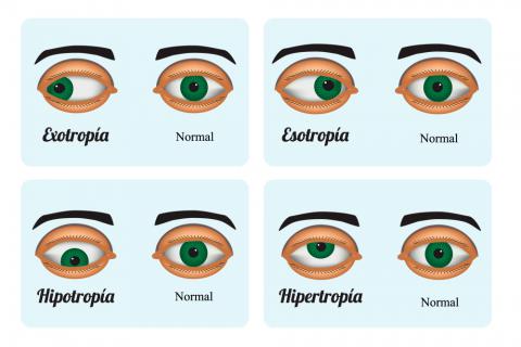 Estrabismo: ¿qué es el estrabismo? Su detección, síntomas, causas y tratamiento de la Asociación Española de Optometristas Unidos Imagen Estrabismo: ¿qué es el estrabismo? Su detección, síntomas, causas y tratamiento de la Asociación Española de Optometristas Unidos