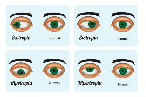 Imagen Estrabismo: ¿qué es el estrabismo? Su detección, síntomas, causas y tratamiento de la Asociación Española de Optometristas Unidos