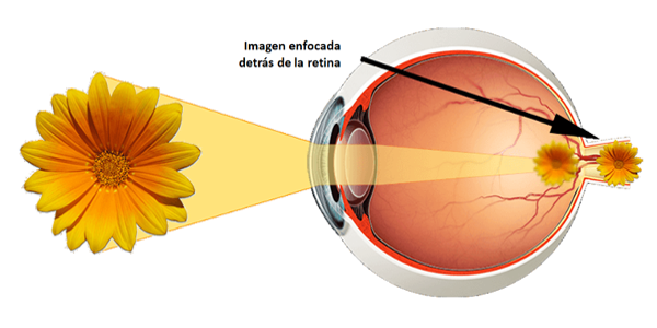 Imagen Hipermetropía: ¿qué es la hipermetropía, síntomas, causas, tratamiento y control? | Asociación Española de Optometristas Unidos