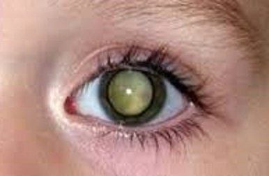 Diagnóstico de la leucocoria de la Asociación Española de Optometristas Unidos Imagen diagnóstico de la leucocoria de la Asociación Española de Optometristas Unidos