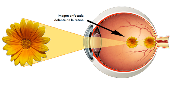 Imagen La miopía: ¿qué es la miopía, sus síntomas, su tratamiento y control? | Asociación Española de Optometristas Unidos