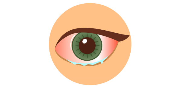 Imagen Queratitis: qué es, síntomas, causas, diagnóstico y tratamiento | Asociación Española de Optometristas Unidos