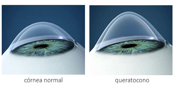 Imagen Queratocono: qué es, síntomas, causas, diagnóstico y tratamiento | Asociación Española de Optometristas Unidos