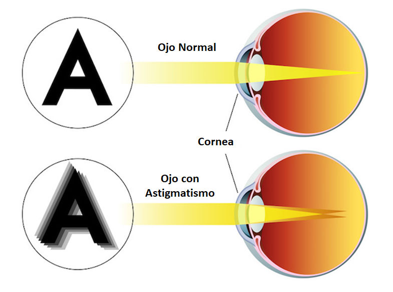 Tipos de astigmatismo, según su existencia. Asociación Española de Optometristas Unidos Tipos de astigmatismo, según su existencia. Asociación Española de Optometristas Unidos