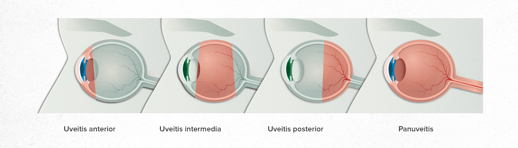 Causas de la uveítis de la Asociación Española de Optometristas Unidos Imagen causas de la uveítis de la Asociación Española de Optometristas Unidos