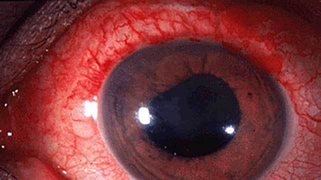 Qué es la uveítis de la Asociación Española de Optometristas Unidos Imagen qué es la uveítis de la Asociación Española de Optometristas Unidos