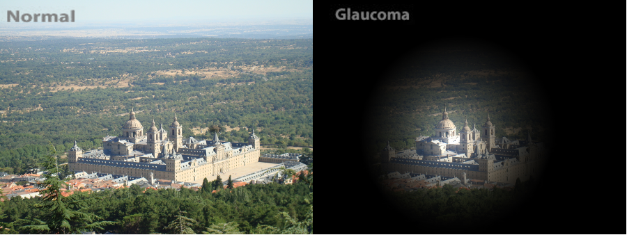 Imagen de la visión normal y visión con glaucoma de la Asociación Española de Optometristas Unidos Imagen de la visión normal y visión con glaucoma de la Asociación Española de Optometristas Unidos